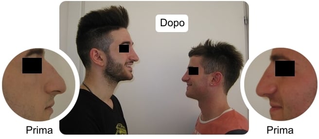 prima-dopo-foto-rinoplastica