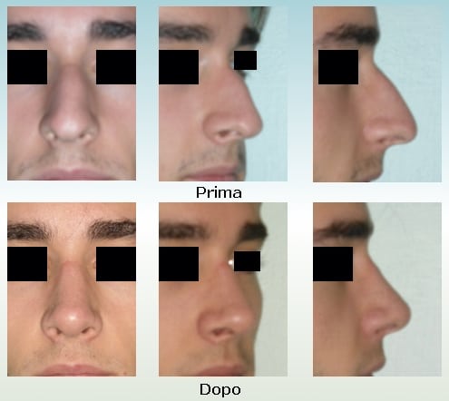 Rinoplastica Uomo Modellamento Del Naso Dell Uomo Rinoplastica Oggi