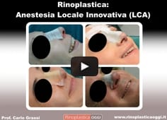 Video: Rinoplastica in Anestesia Locale Innovativa